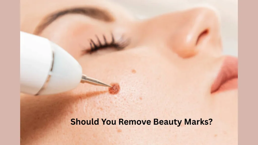 Should You Remove Beauty Marks?